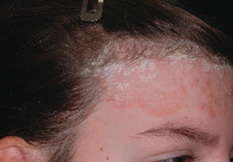Nấm da đầu xuất hiện những mảng trắng lớn gây ngứa